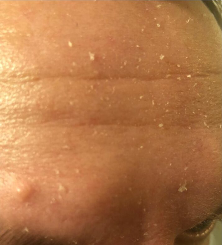 A mans skin before using Neostrata Bionic Face Cream
