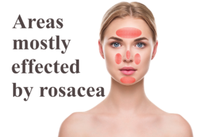 Areas affected by Rosacea